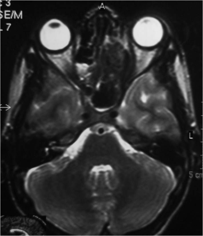 Click here to enlarge image Unilateral maxillary sinusitis CT PNS
