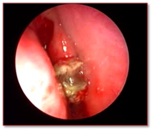 Click here to enlarge image Unilateral maxillary sinusitis CT PNS